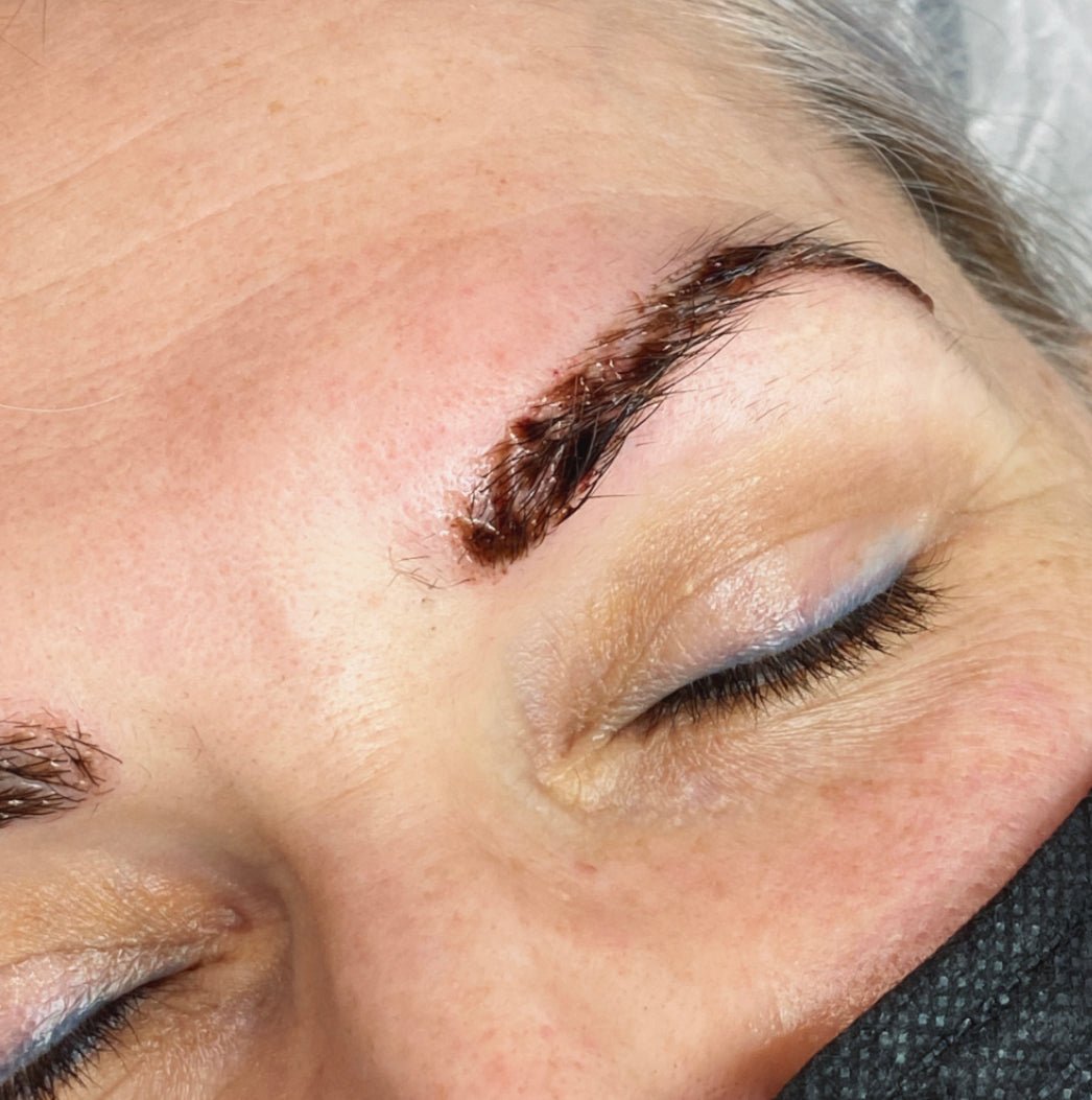 Cosmetic Tattoo Removal