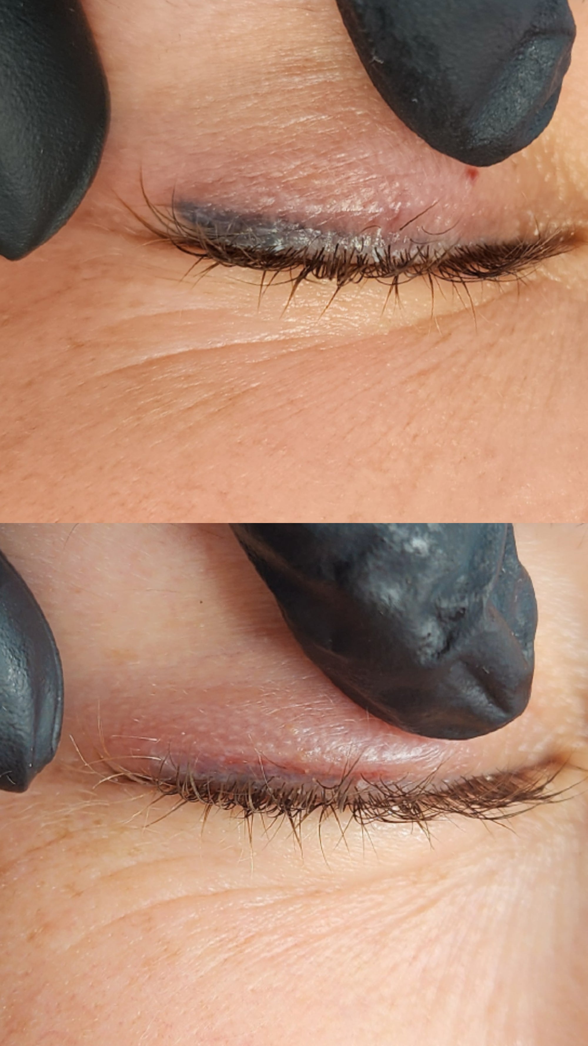 Cosmetic Tattoo Removal