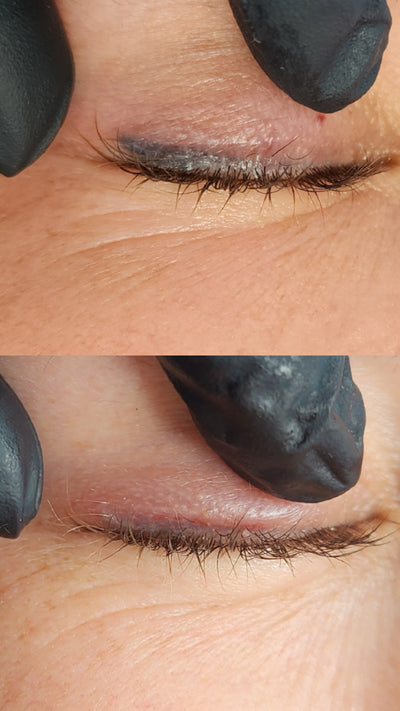 Cosmetic Tattoo Removal