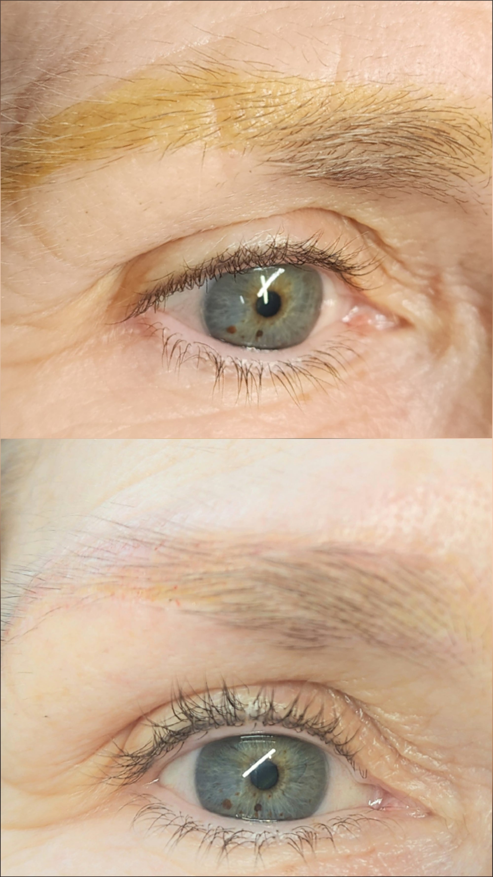 Cosmetic Tattoo Removal