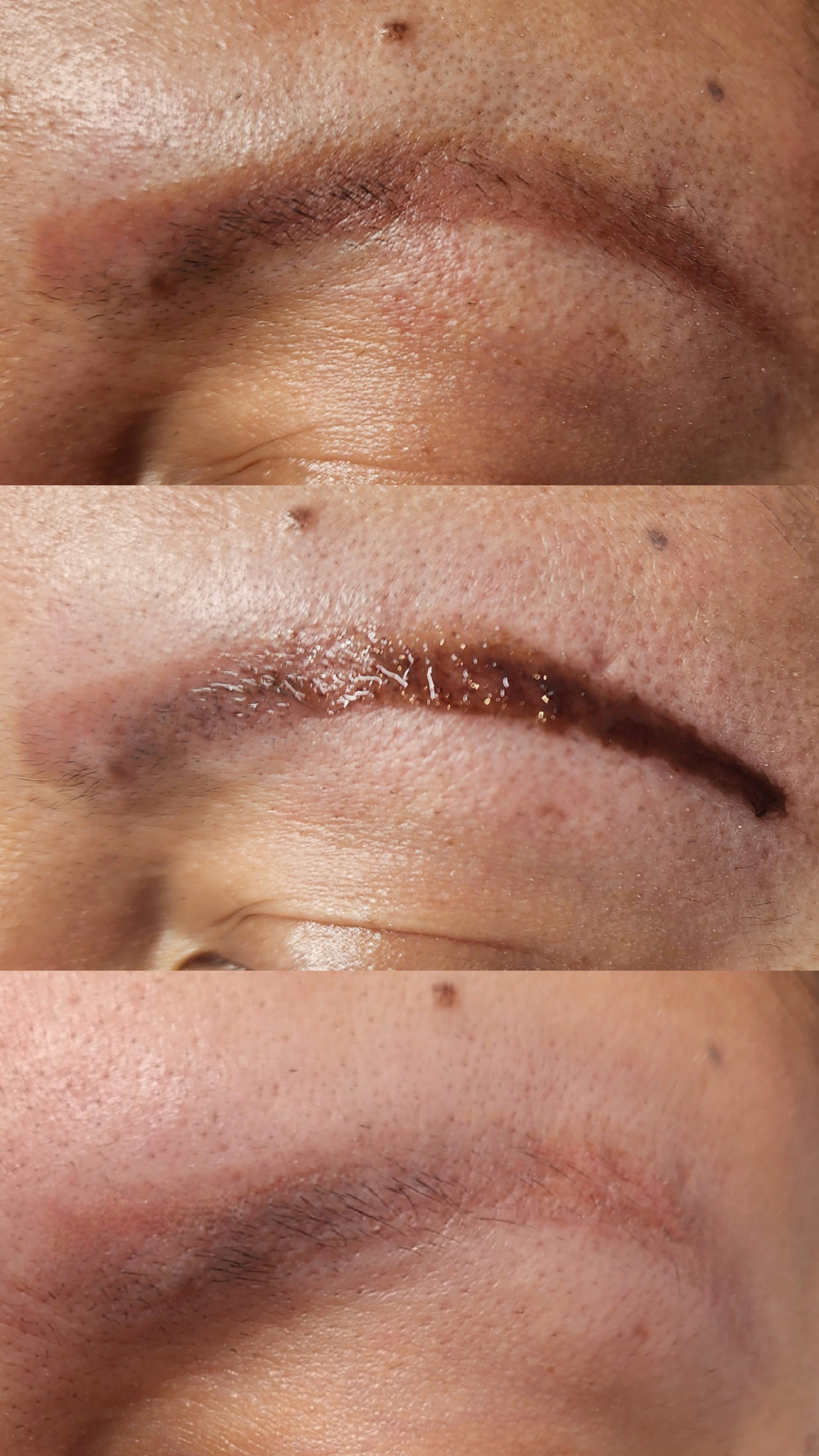 Cosmetic Tattoo Removal