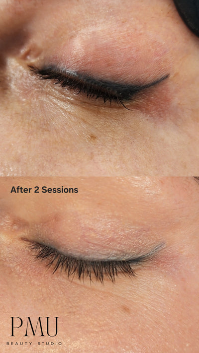 Cosmetic Tattoo Removal