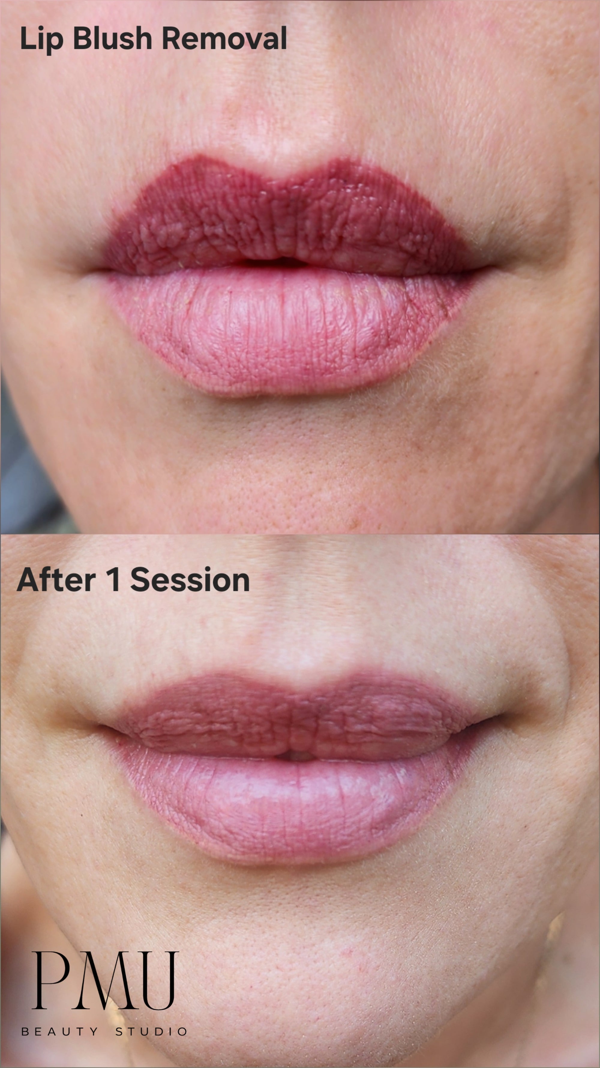 Cosmetic Tattoo Removal