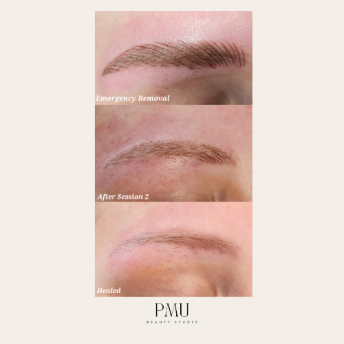 before and after of eyebrow tattoo removal