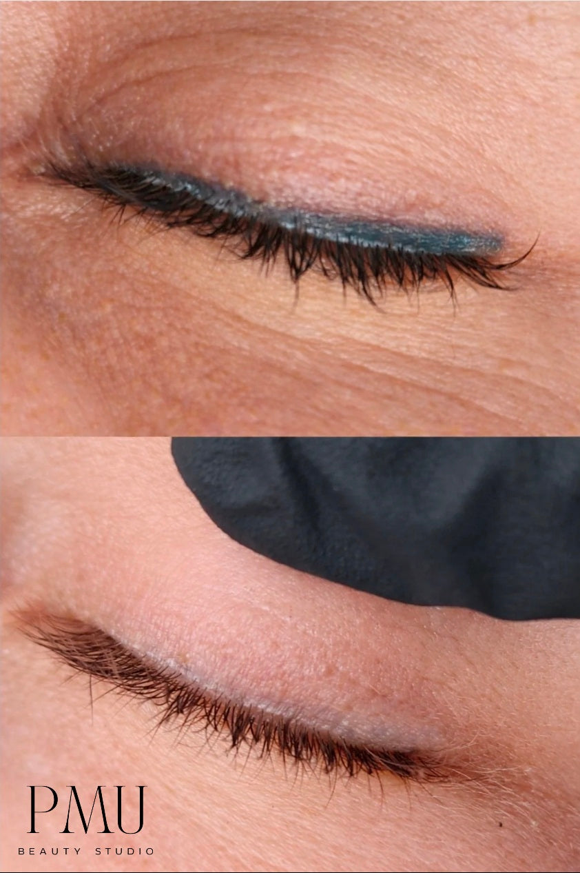 Cosmetic Tattoo Removal
