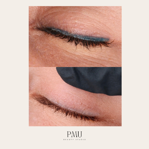 laser eyeliner removal