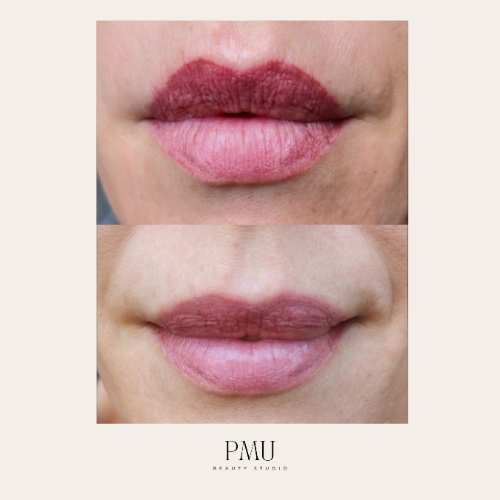 lip blush removal auckland