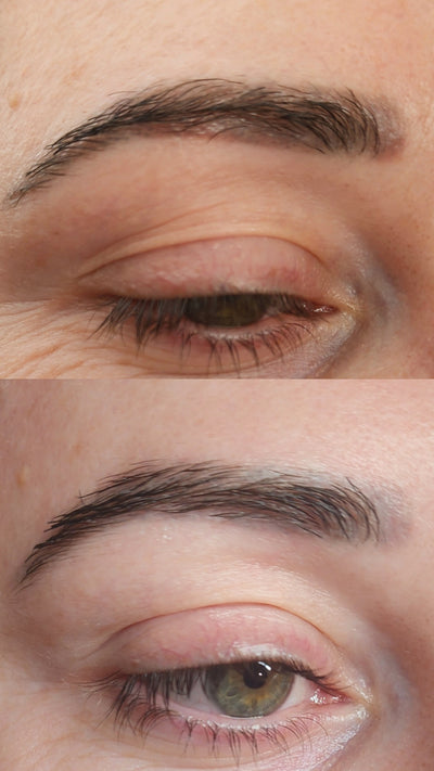 Cosmetic Tattoo Removal