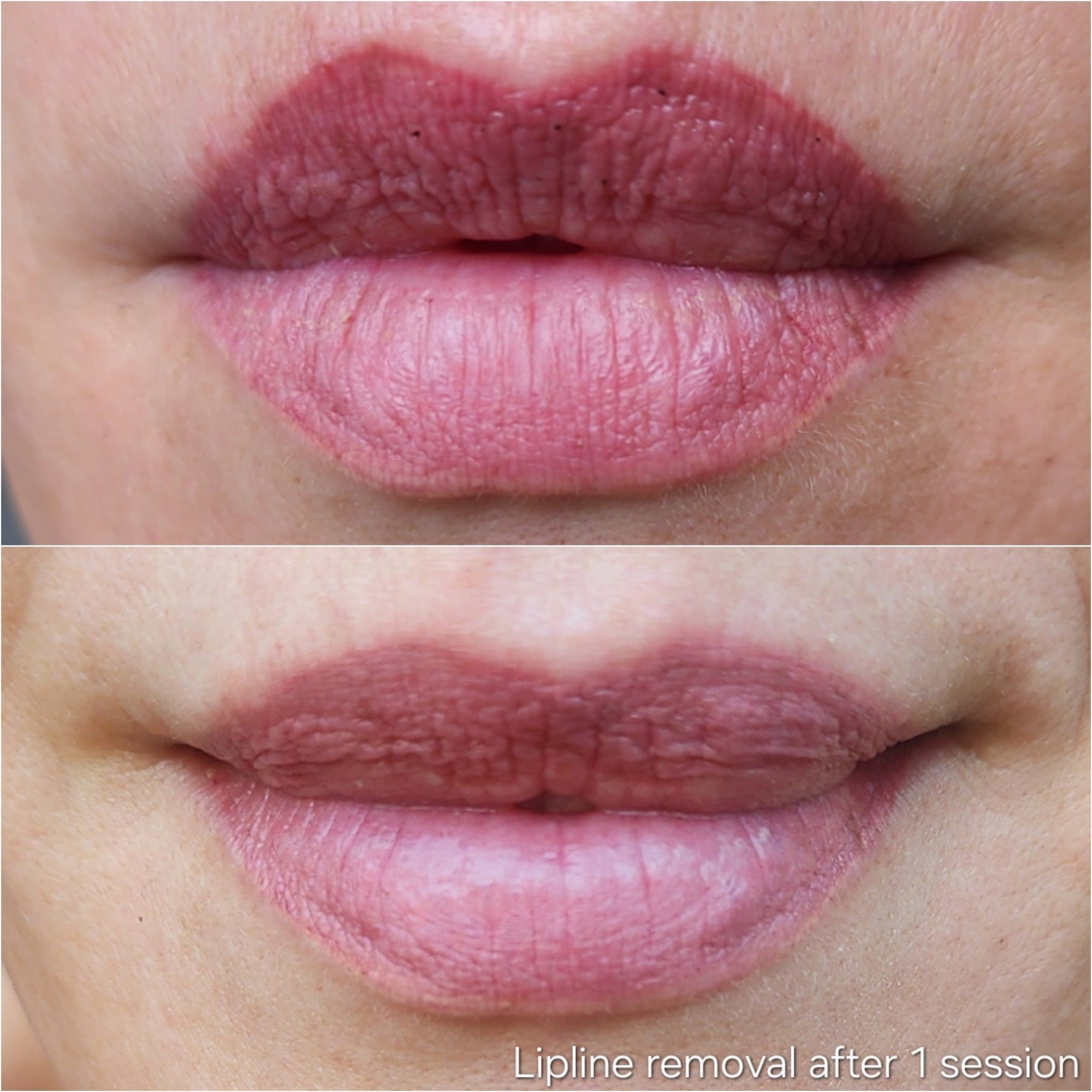 Cosmetic Tattoo Removal