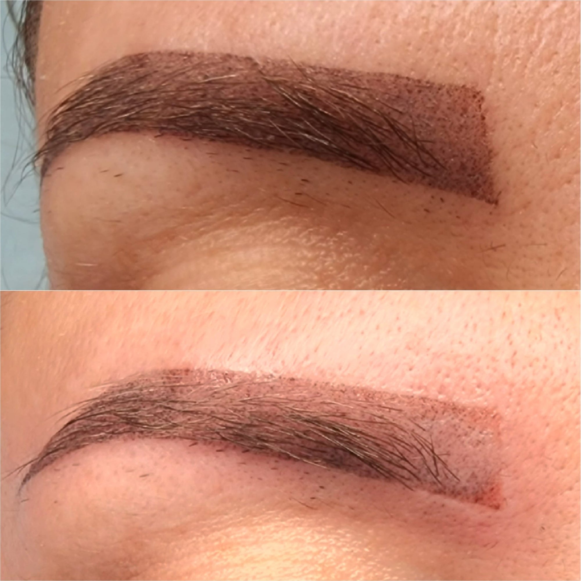 Cosmetic Tattoo Removal