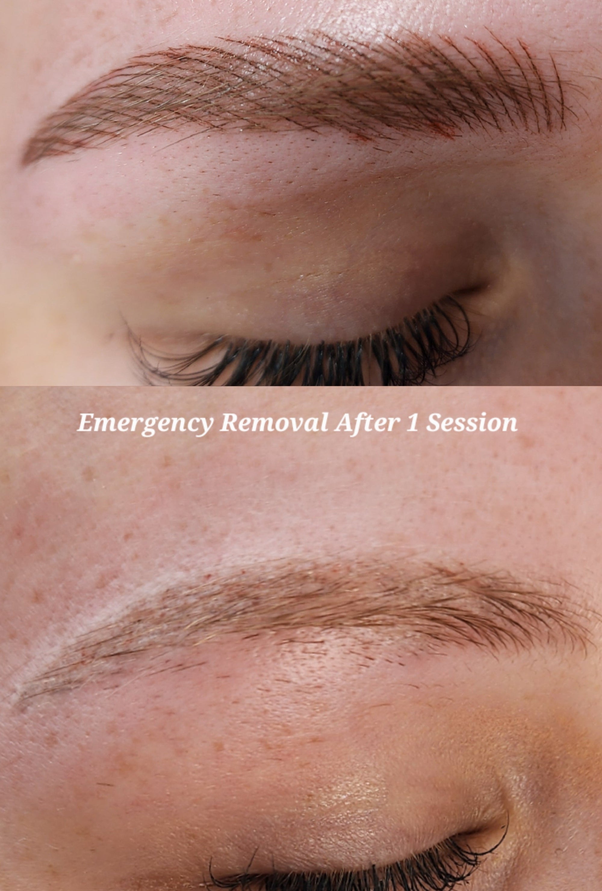 Cosmetic Tattoo Removal