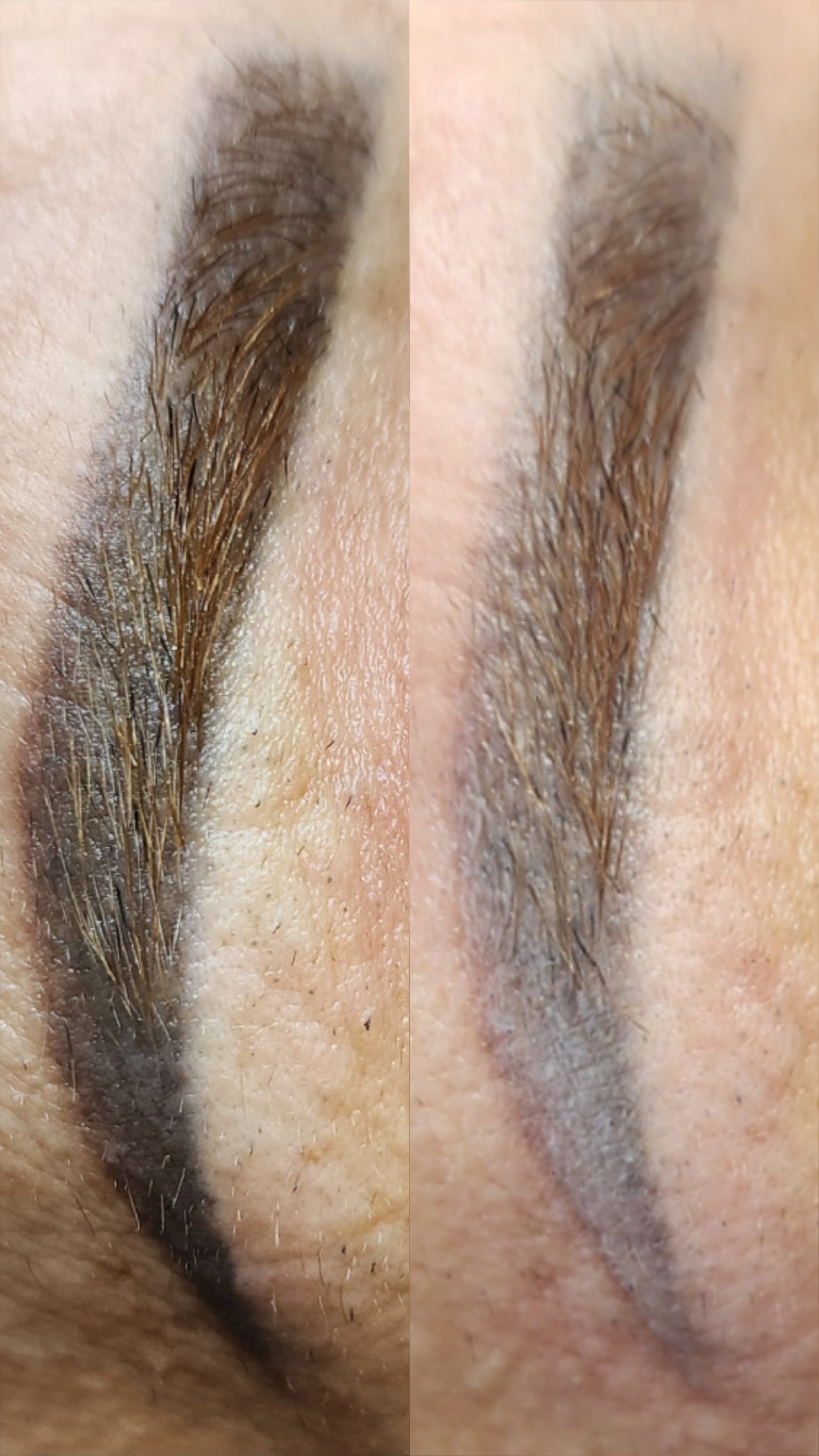 Cosmetic Tattoo Removal
