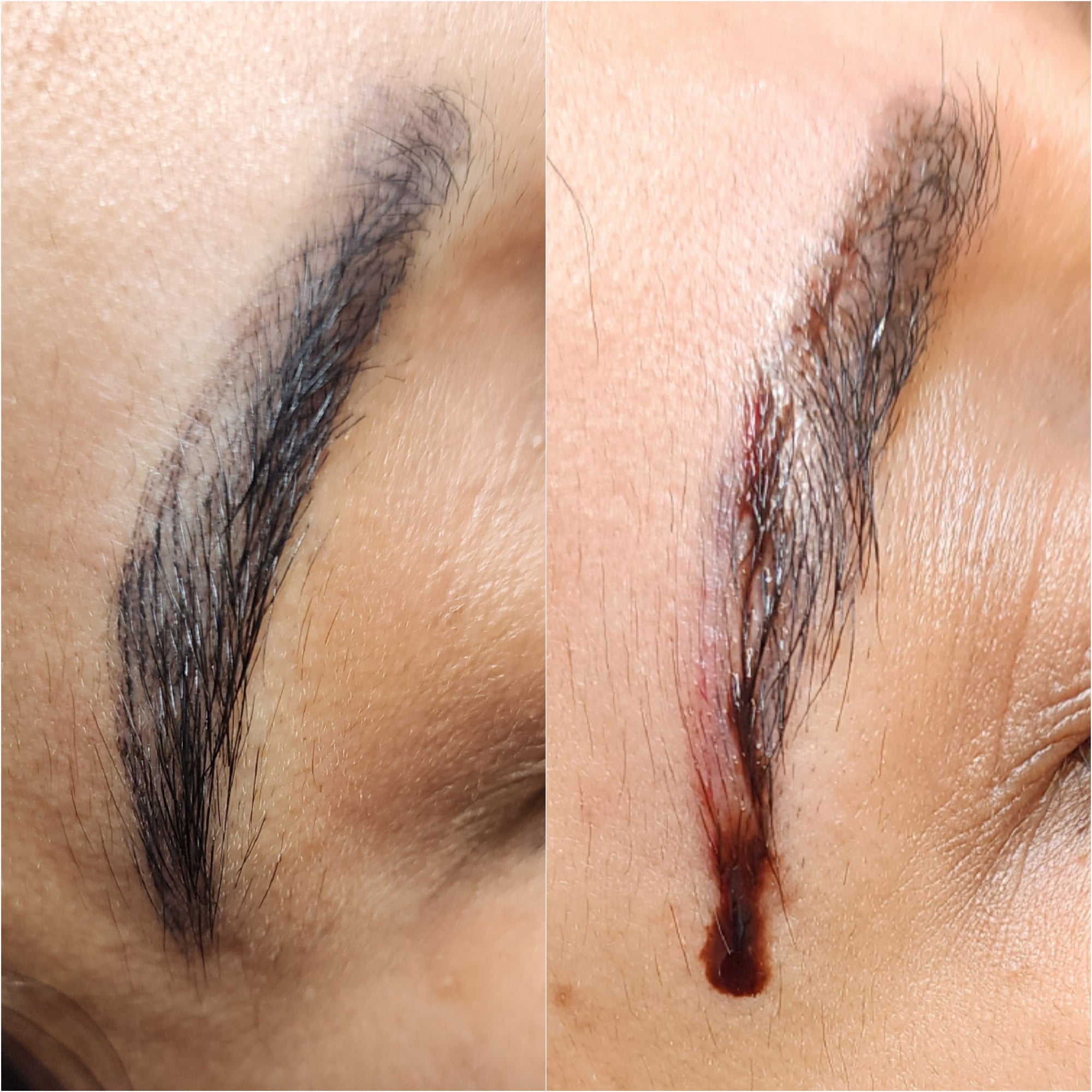 Cosmetic Tattoo Removal