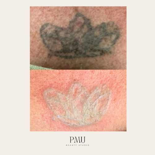 Before and after comparison of tattoo removal